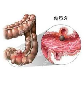运城众泰肛肠医院：结肠炎的症状表现有哪些？