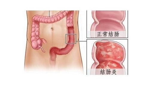 运城众泰肛肠医院：虎视眈眈的结肠炎