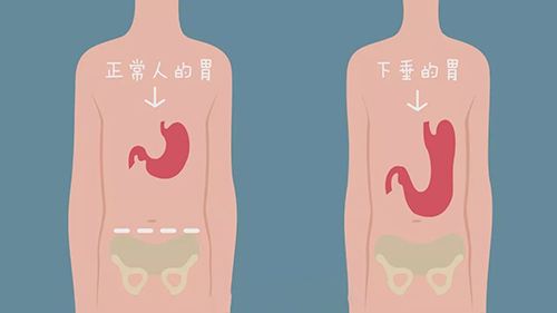 运城众泰肛肠医院：胃下垂如何治疗，如何预防? 
